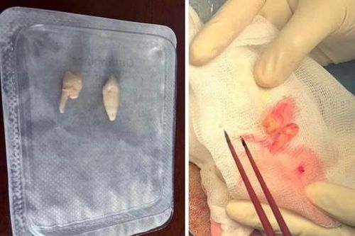 Tây Ninh:  Cứu sống nam sinh bị răng người khác cắm sâu vào não