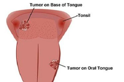 Các giai đoạn của ung thư lưỡi