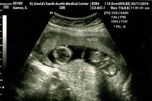Selena và Justin bị tung ảnh siêu âm song thai giả