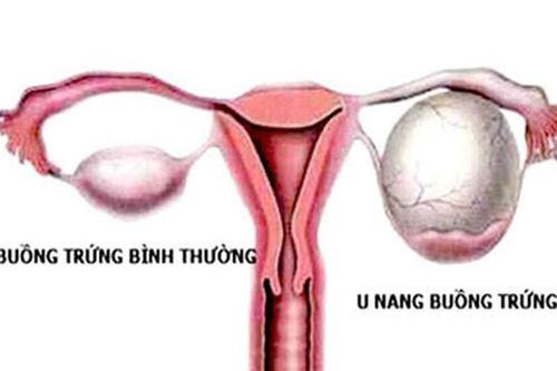 Sự khác biệt giữa ung thư buồng trứng và tử cung