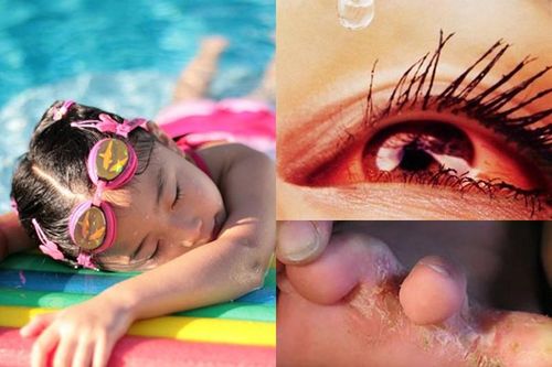 10 bệnh bé yêu dễ mắc khi đi bơi mùa hè