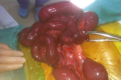 Cứu bệnh nhân tắc ruột do túi thừa Meckel