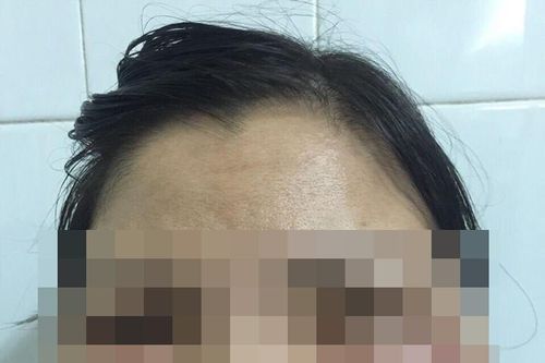 Biến dạng khuôn mặt sau khi tiêm thuốc làm trắng da