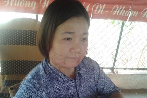 Kí ức kinh hoàng của người phụ nữ bị người yêu thiêu sống