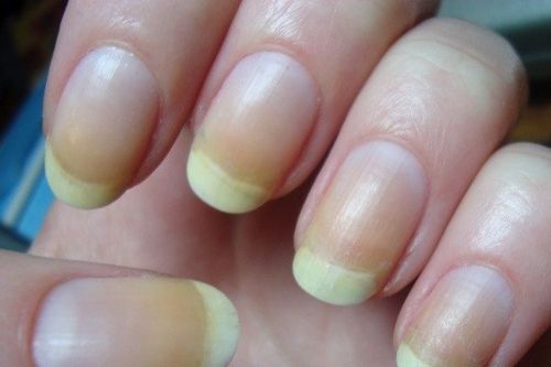 9 dấu hiệu bất thường ở móng tay cảnh báo sức khỏe bạn đang gặp vấn đề