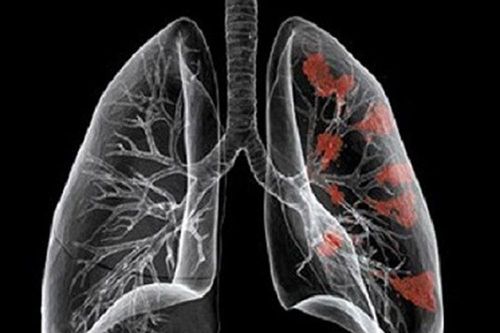 Tác nhân gây các bệnh nguy hiểm về phổi