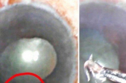 Rùng rợn hình ảnh ký sinh trùng sống trong mắt người phụ nữ Ấn Độ