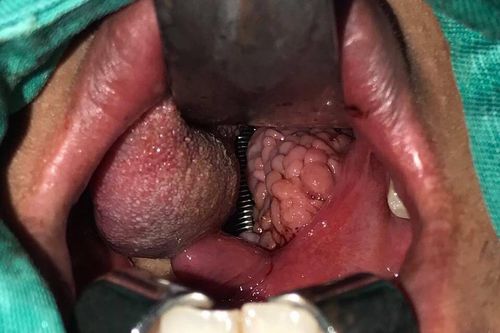Khủng khiếp amidal sần sùi, nổi cục như chùm nho chèn kín đường thở