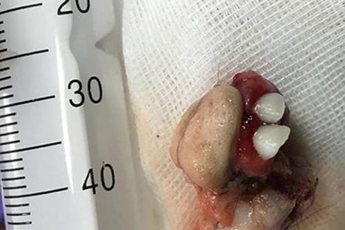Khối u quái có răng, tóc, xương trong buồng trứng bé gái