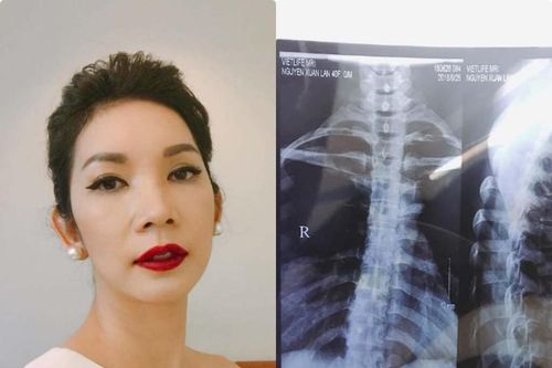 Điều ít biết về căn bệnh khiến siêu mẫu Xuân Lan không thể mang giày cao gót