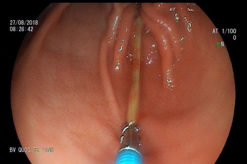 Hy hữu: Người đàn ông ở Nghệ An nuốt phải tăm dài 7cm vì ngủ quên