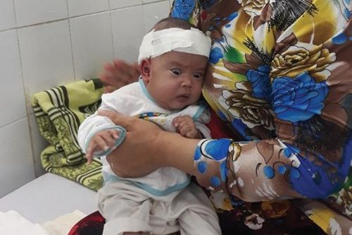 Bé sơ sinh bị não úng thủy và thoát vị tủy cần giúp đỡ