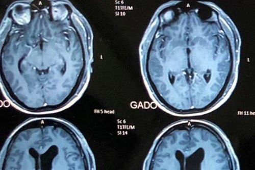 Cứu sống ngoạn mục người đàn ông có khối u khổng lồ trong não