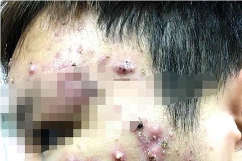 Dùng mỹ phẩm không rõ nguồn gốc, nhiều nữ sinh bị 'nát mặt'