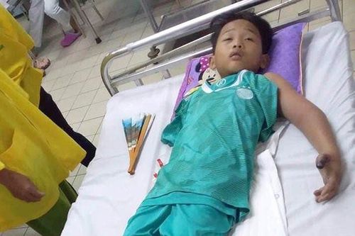 Ra đồng bắt cua cùng bố, bé trai 11 tuổi bị rắn hổ mang cắn nguy kịch