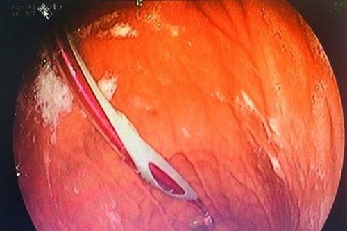 Lấy bàn chải chữa hóc xương cá, vô tình nuốt luôn cả bàn chải