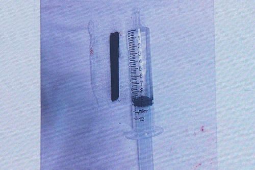 Đoạn đũa dài 7cm nằm trong hốc mắt bệnh nhân hơn 4 năm