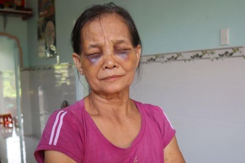 Phạt 2 triệu đồng con dâu đánh mẹ chồng tím mặt ở Bình Phước
