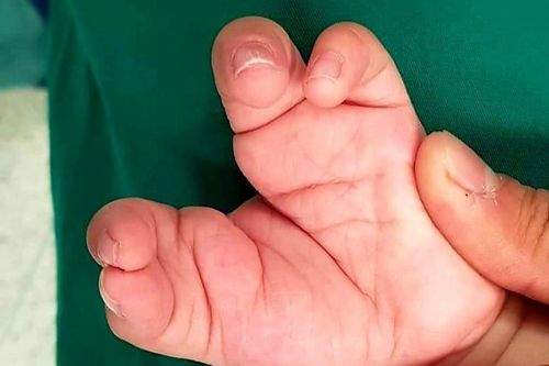 Phẫu thuật tạo hình bàn tay 'càng cua' cho bé trai 2 tuổi ở Sài Gòn