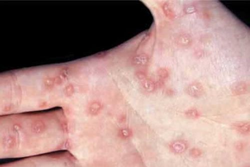 Bé trai 13 tuổi mắc bệnh giang mai sau 1 năm bị lạm dụng tình dục