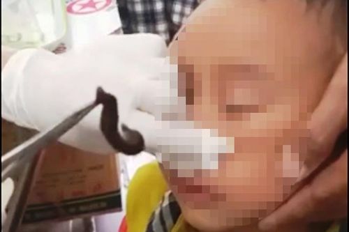 Đỉa dài 10 cm sống trong mũi bé trai