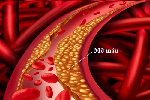 Phòng chống máu nhiễm mỡ