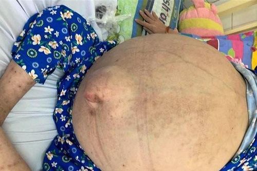 Chứng bệnh lạ khiến cô gái 19 tuổi bị ứ 40 lít nước trong bụng