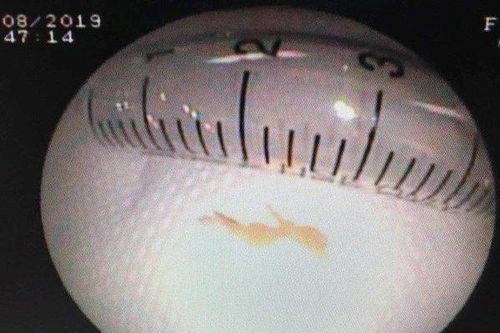 Cứu sống bé gái người Lào bị mắc xương cá trong phế quản cả tháng trời