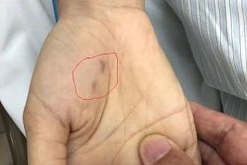 Bệnh dại tăng bất thường