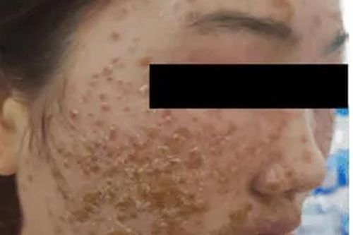 Nhập viện vì đẹp da bằng loại bột quảng cáo trên mạng