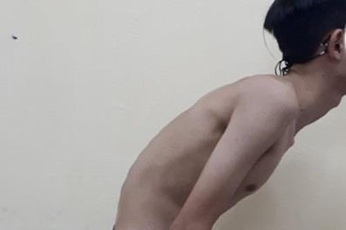 Chữa gù cho thanh niên 22 tuổi
