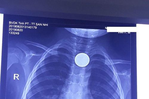 Sau tiếng khóc thét, đồng xu trôi tọt vào thực quản bé trai 3 tuổi