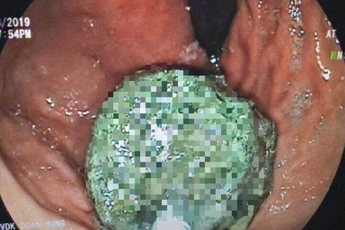 Thường xuyên uống trà sữa thay cơm, chàng trai trẻ phát hiện thứ kinh hoàng trong bụng