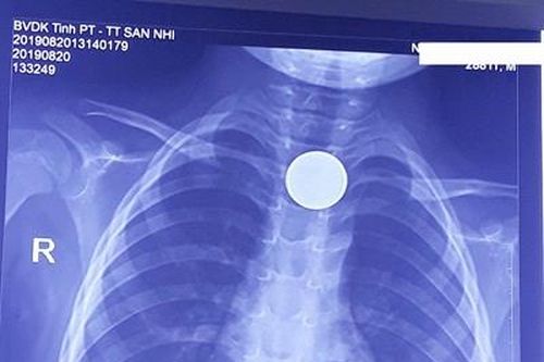 Cấp cứu kịp thời trẻ 3 tuổi bị hóc dị vật do nuốt đồng xu