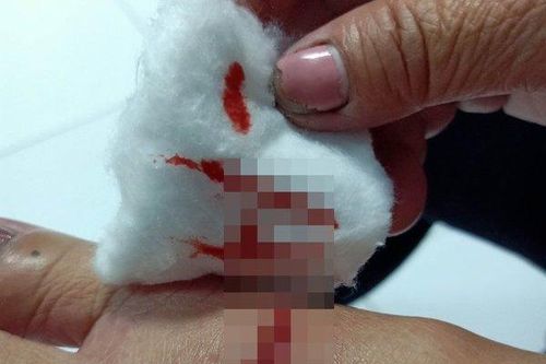 Vụ chó cắn 7 người bị thương ở Cà Mau: Mẫu chó dương tính với bệnh dại