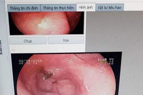 Bà cụ nuốt tăm tre dài 7 cm, bị đâm thủng dạ dày