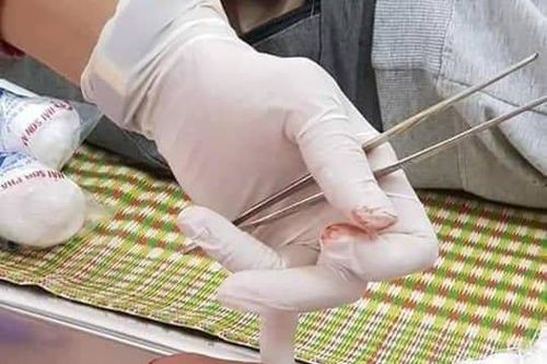 Điện thoại phát nổ 9x bị bỏng nặng khi bỏ chạy vấp vào phích nước sôi