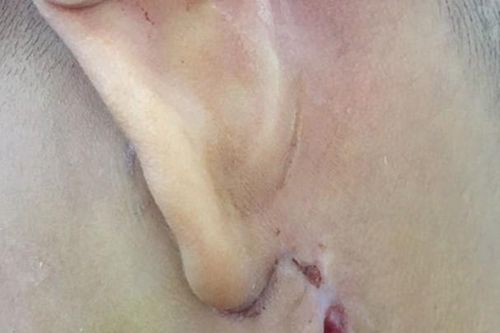Nghệ An: Phát hiện 3 trẻ nhiễm vi khuẩn 'ăn thịt người'