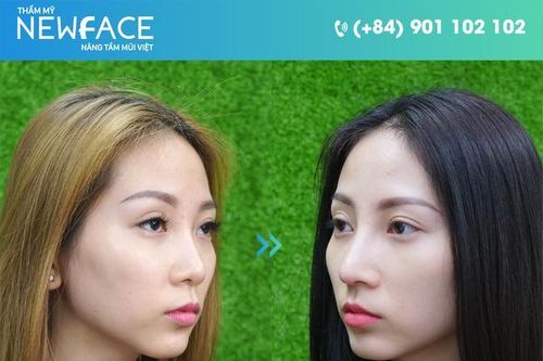 Nguyễn Thủy: 'Tôi đã thực sự lột xác thần kỳ sau nâng mũi tại Thẩm mỹ NEWFACE