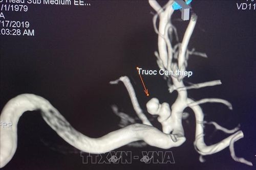 Cứu sống bệnh nhân bị vỡ túi phình mạch máu não