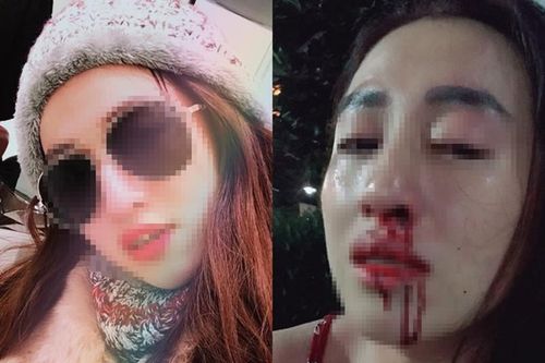 Vợ xinh bị chồng đánh gãy mũi ở TP HCM: nên 'oánh' trả... còn không, ly hôn?