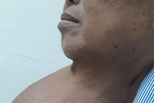 Người phụ nữ 20 năm phải quàng khăn cổ để che, đỡ khối u bướu khổng lồ