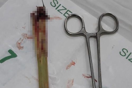 Lấy thành công dị vật dài 20cm đâm xuyên da bụng bé trai ở Hà Tĩnh