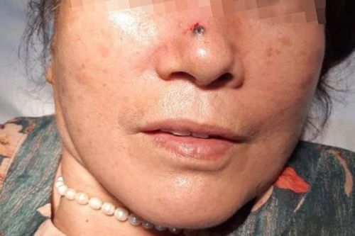Phát hiện ung thư do có nốt sùi trên sống mũi