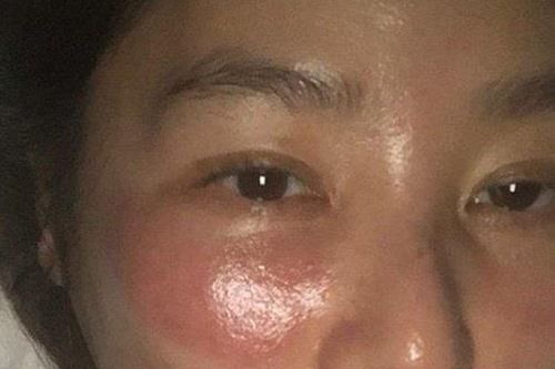 Kim Sung Ryung bị bỏng rát vì đắp mặt nạ qua đêm