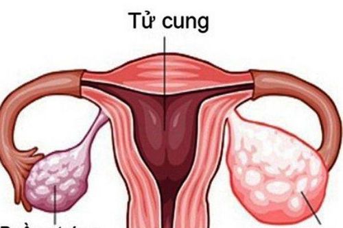 Căn bệnh ung thư phụ nữ hay gặp phải có yếu tố di truyền