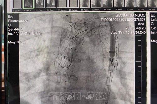 Phẫu thuật thành công bệnh nhân bị bóc tách động mạnh chủ