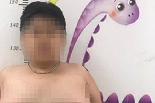 Bé trai rậm lông, ngực nở như con gái vì lạm dụng thuốc corticoid