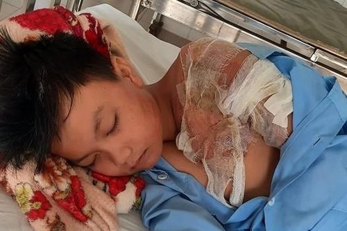 Bé trai 11 tuổi bị cha tạt nước sôi