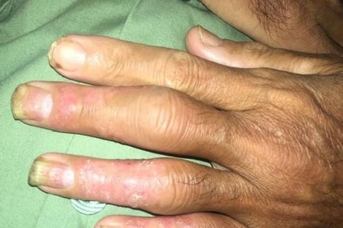 Coi chừng tàn phế khi bị viêm khớp vẩy nến
